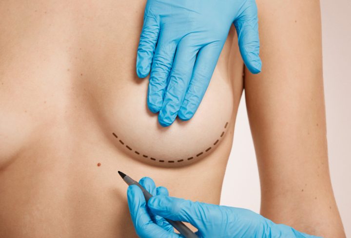 woman-marked-out-cosmetic-surgery